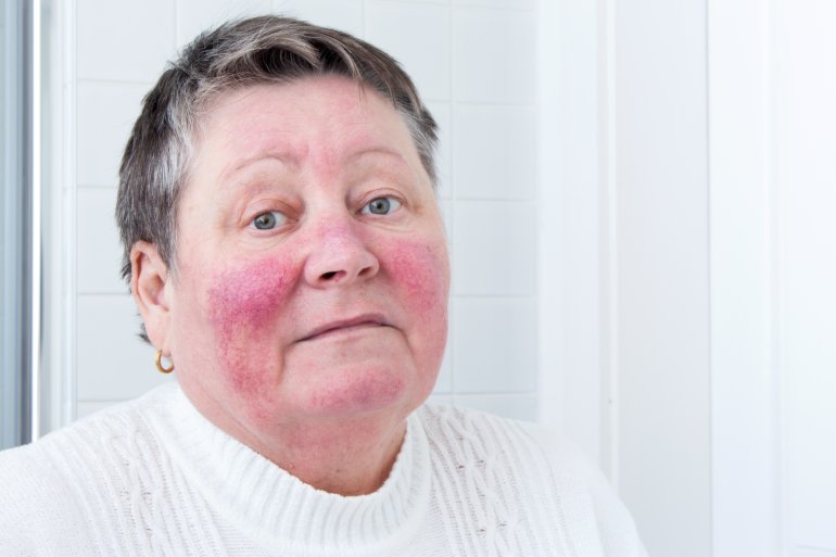 Frau mit Rosacea im Gesicht