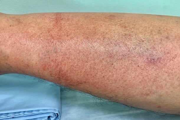 Cellulitis