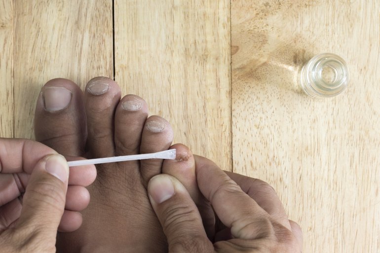 Frau behandelt Nagelpilz mit Ciclopirox