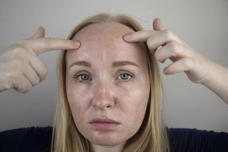 Frau mit fettiger Haut im Gesicht