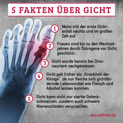 5 Fakten über Gicht (Infografik)