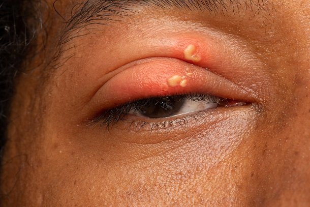 Herpes am Auge