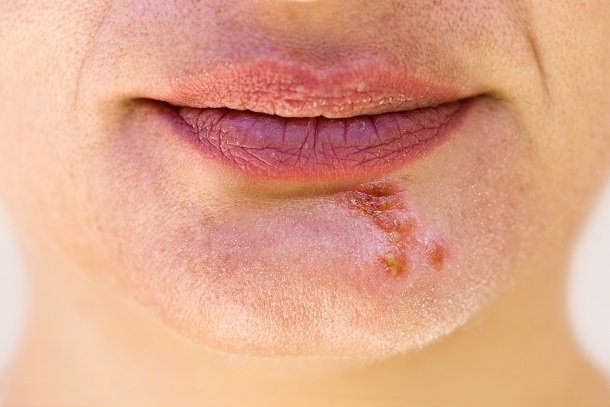 Herpes im Gesicht, zum Beispiel am Kinn 