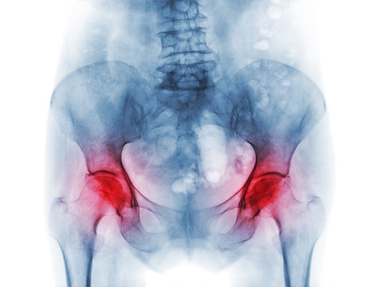 Coxarthrose im Röntgenbild