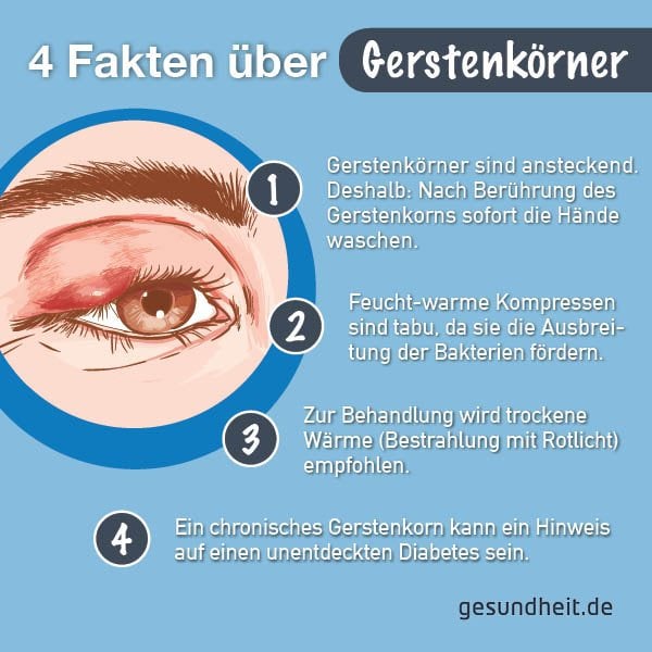 4 Fakten über Gerstenkörner (Infografik)