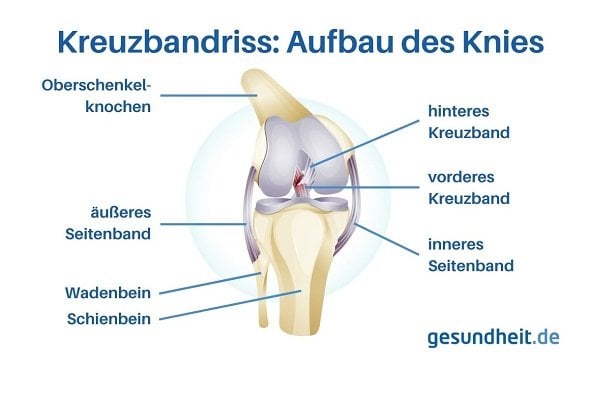 Aufbau eines Knies mit Kreuzbandriss (Infografik)