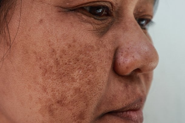 Melasma