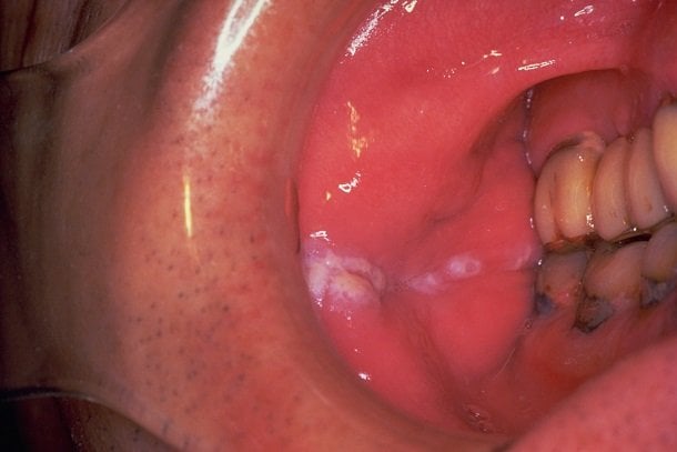 Orale Leukoplakie