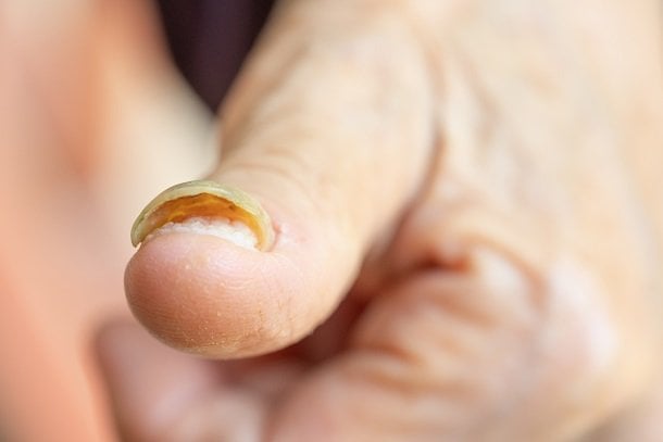 Nagelplatte kann sich bei Nagelpilz lösen