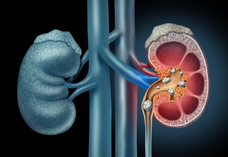 Nierensteine (anatomische Illustration)