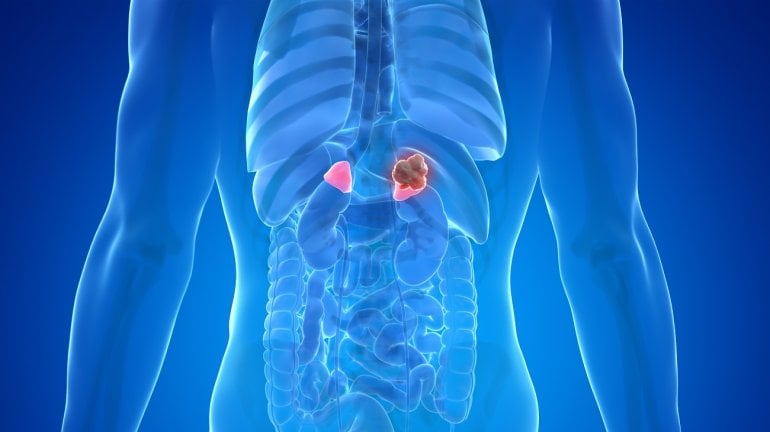 Phäochromozytom (Tumor an der Nebenniere) als Illustration