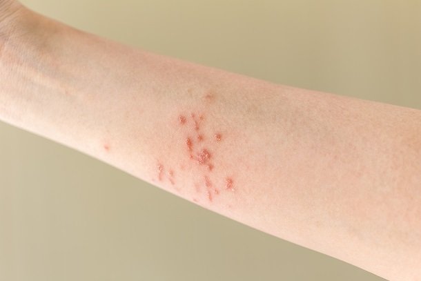 Psoriasis guttata