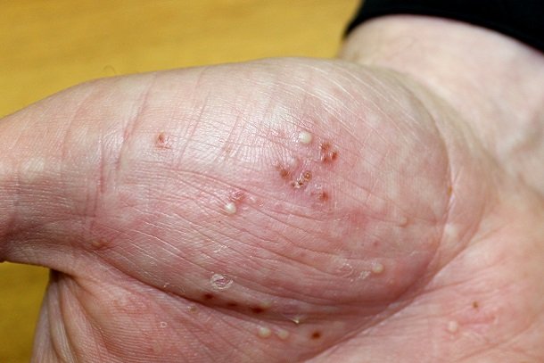 Psoriasis pustulosa