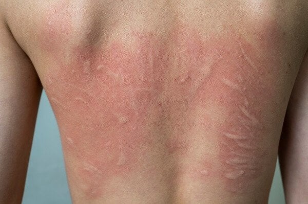 Urticaria factitia (Reibungs-Nesselsucht)